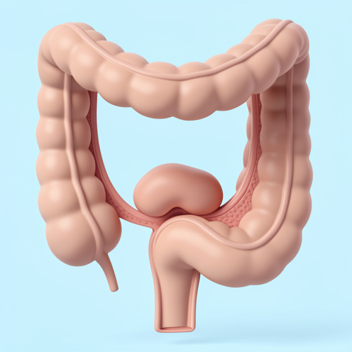 Illustration médicale non graphique montrant un bourrelet hémorroïdaire interne dans le canal rectal.