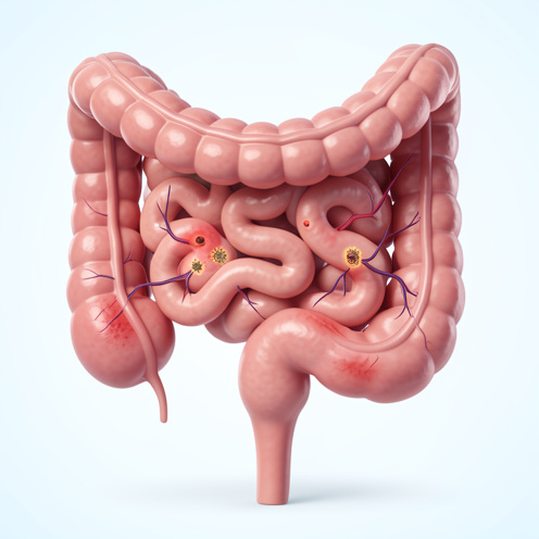 Illustration médicale en 3D du canal anal montrant des lésions localisées associées au papillomavirus et des veines hémorroïdaires élargies.